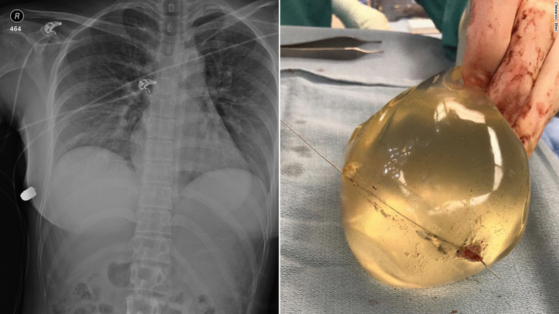 El implante mamario de una mujer refleja una bala y le salva la vida.