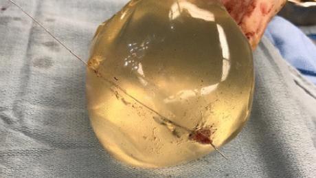 Una vista intraoperatoria del implante mamario izquierdo que muestra la trayectoria de la bala a través del implante.
