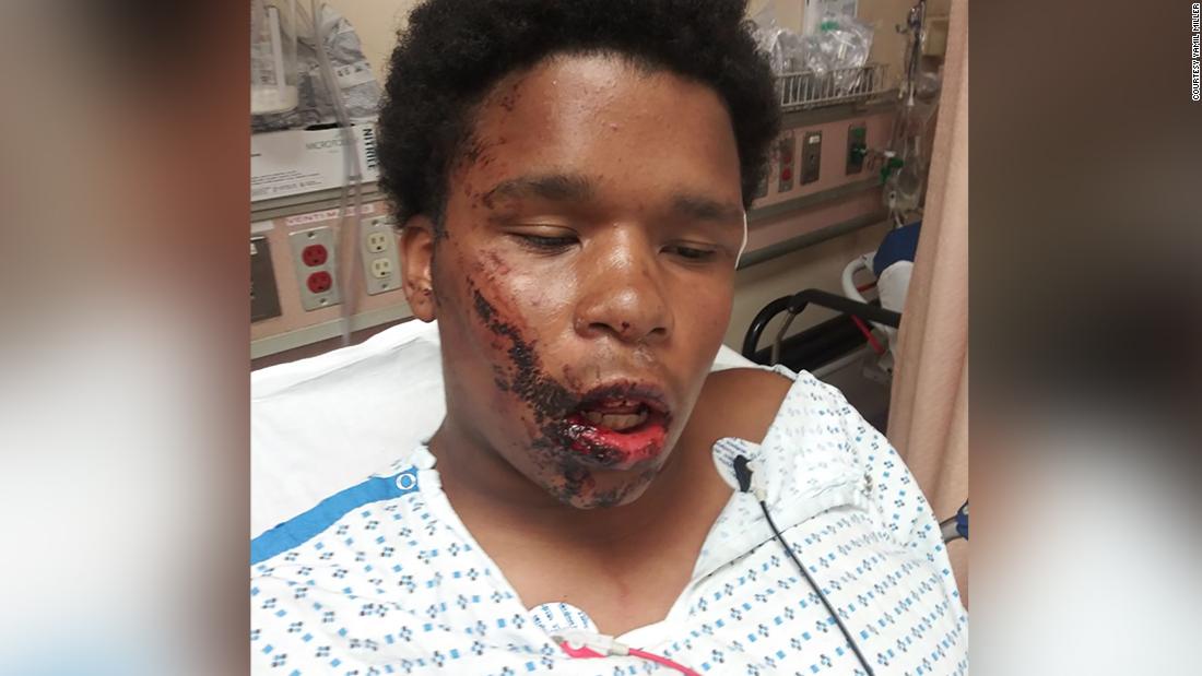 El Bronx adolescente sufre una fractura facial luego de ser presuntamente perseguido por la policía de Nueva York, según un abogado de CNN
